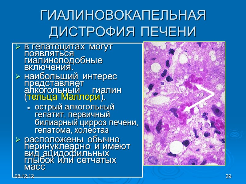 ГИАЛИНОВОКАПЕЛЬНАЯ ДИСТРОФИЯ ПЕЧЕНИ в гепатоцитах могут появляться гиалиноподобные  включения.  наибольший интерес представляет